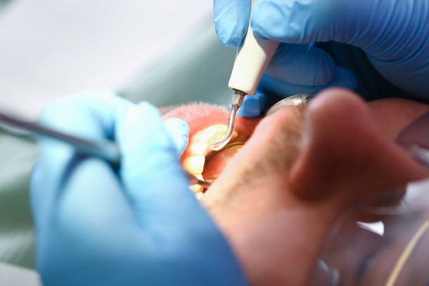 Best Emergency Treatment for Oral Infections in South Fulton, GA